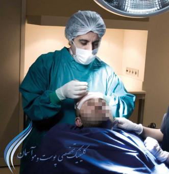 کاشت مو- پیوند مو-کاشت موی طبیعی