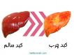 درمان قطعی کبد چرب ، بیماری خاموش!